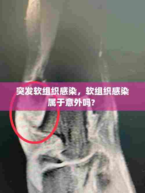 突发软组织感染,软组织感染属于意外吗?